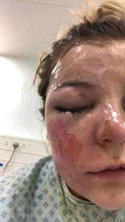 Mujer pierde un ojo por hervir huevos en un microondas