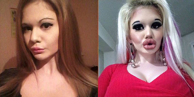 Quiere tener los labios más grandes del mundo; lleva más de 15 operaciones
