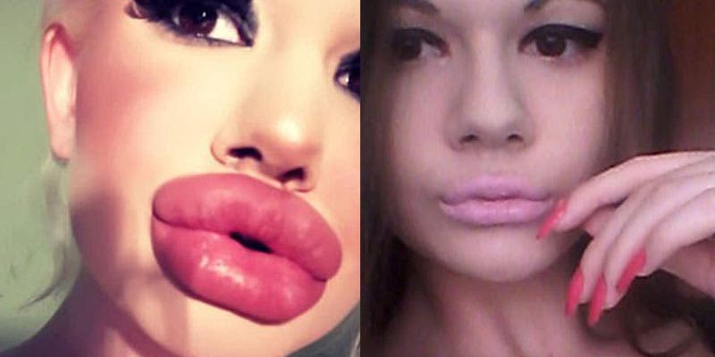 Quiere tener los labios más grandes del mundo; lleva más de 15 operaciones