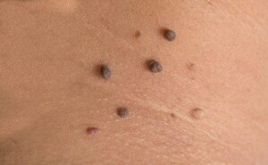 Verrugas en el cuerpo: Causas, síntomas, tratamiento y prevención