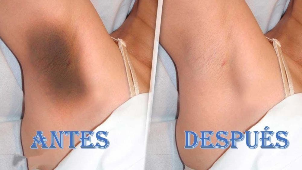 Aclara tus axilas con papa y levanta los brazos sin preocupación