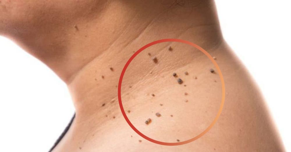 Belleza | Elimina las verrugas con vinagre de manzana