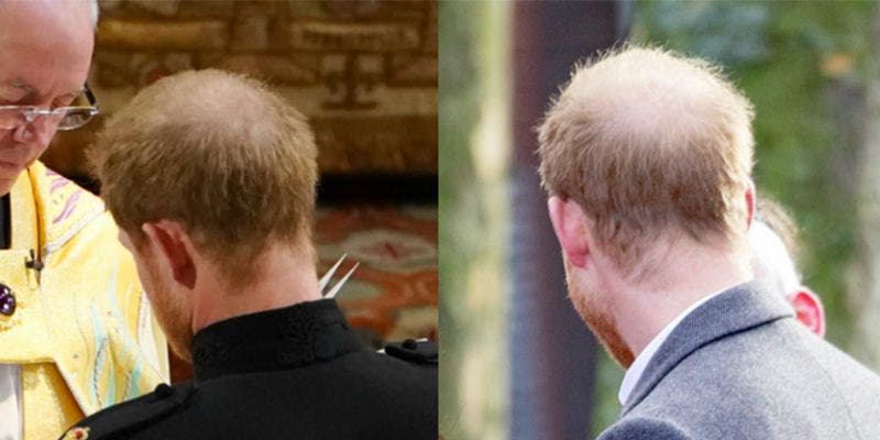 Príncipe Harry se somete a tratamiento para evitar la calvicie