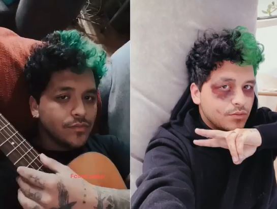 Christian Nodal aparece con golpes en la cara ¿Belinda le pegó?