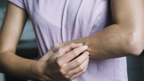 Dermatitis atópica, padecimiento que prevalece en la Península de Yucatán.