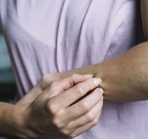 Dermatitis atópica, padecimiento que prevalece en la Península de Yucatán.