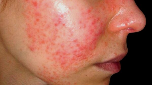 Científicos de la UNAM que buscan tratar la lupus, invitan a yucatecos a registrarse en plataforma