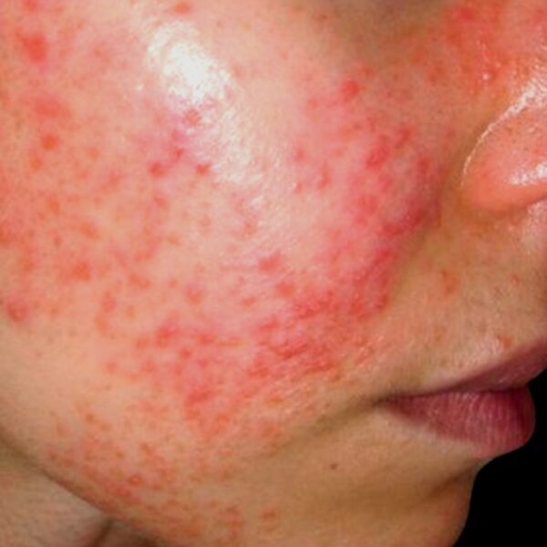 Científicos de la UNAM que buscan tratar la lupus, invitan a yucatecos a registrarse en plataforma