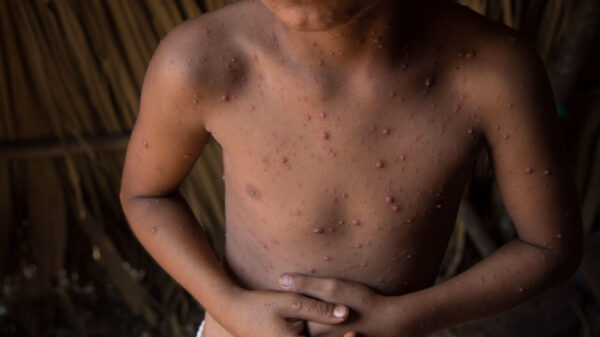 Alarman cifras de contagios por Varicela en Quintana Roo