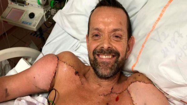 El paciente que fue sometido a trasplante doble de brazos, dio a conocer que ya puede flexionar los bíceps