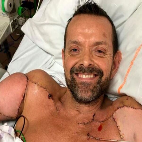 El paciente que fue sometido a trasplante doble de brazos, dio a conocer que ya puede flexionar los bíceps