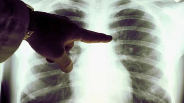 ¡Cuidado! El Covid-19 podría elevar casos de cáncer de pulmón