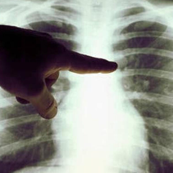 ¡Cuidado! El Covid-19 podría elevar casos de cáncer de pulmón