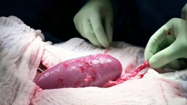 ¡Increíble! Todo un éxito trasplante de riñón de cerdo a paciente humano