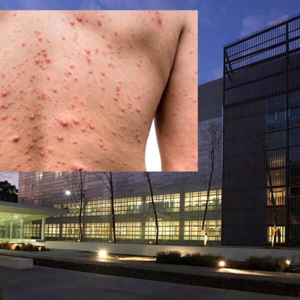 Lanza Sesa alerta nacional por Viruela del Mono