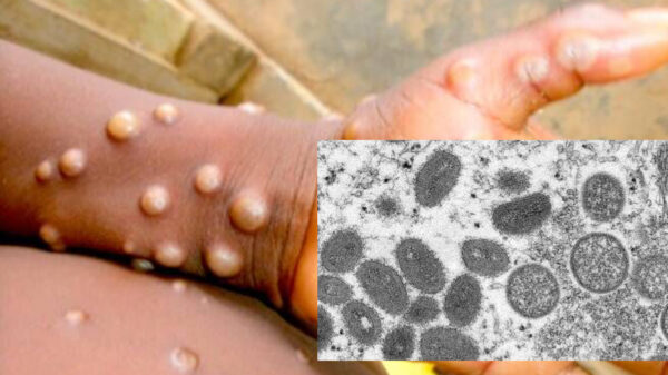 Lo que faltaba, ahora "viruela del mono", detectan 14 casos