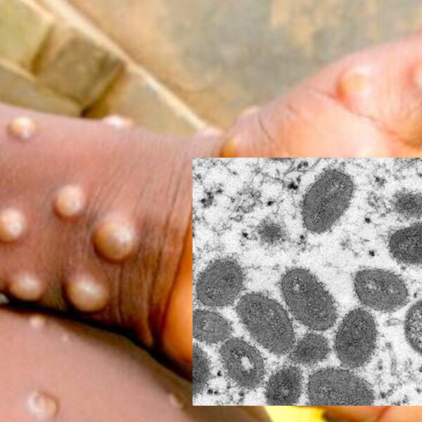 Lo que faltaba, ahora "viruela del mono", detectan 14 casos