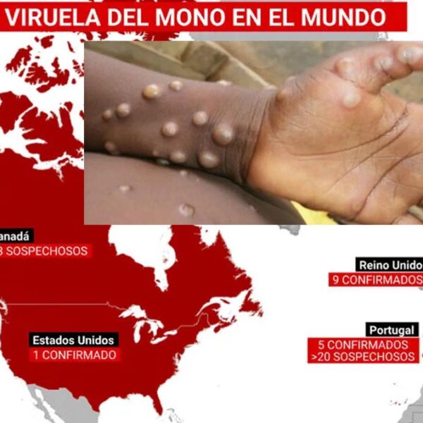 Se acerca Viruela del Mono a México, detectan casos en EEUU y Canadá
