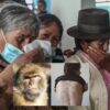 Viruela del Mono causa alerta sanitaria en Perú