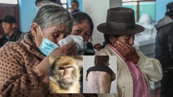 Viruela del Mono causa alerta sanitaria en Perú