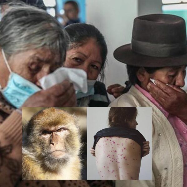 Viruela del Mono causa alerta sanitaria en Perú