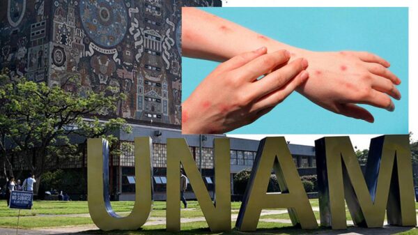 Recomienda la UNAM no confiarse ante Viruela del Mono