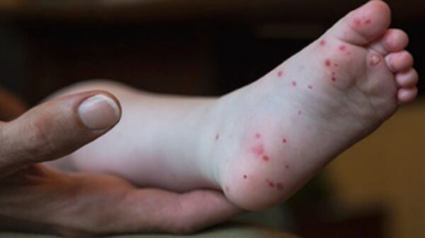 Enfermedades raras; afecta virus Coxsackie a niños hasta de 10 años