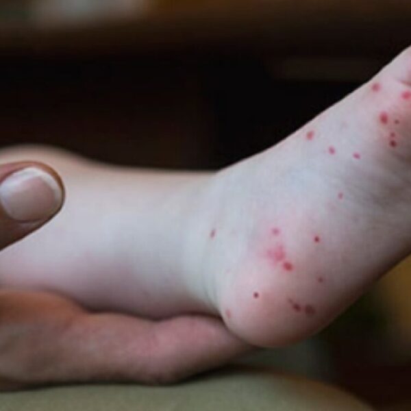 Enfermedades raras; afecta virus Coxsackie a niños hasta de 10 años