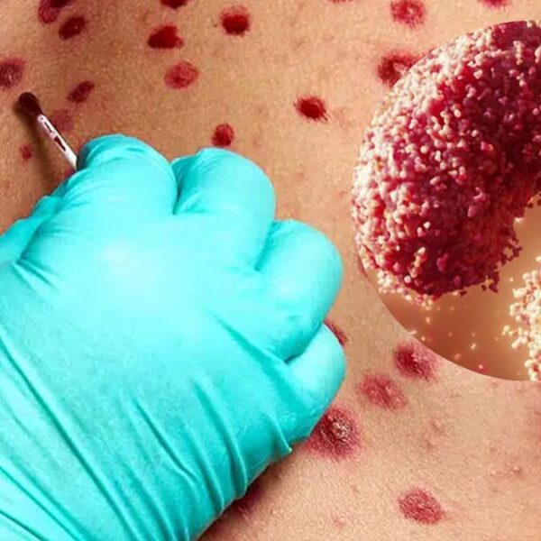 Convoca OMS a reunión urgente por viruela del mono