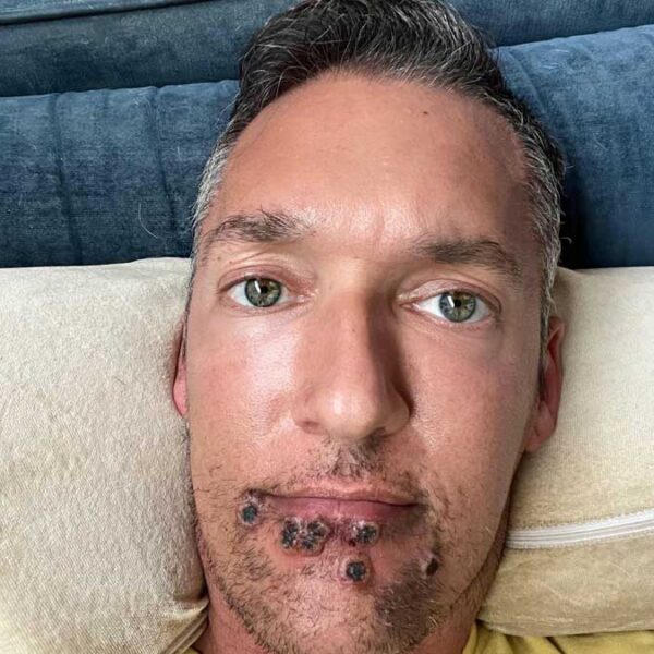 Actor de cine para adultos muestra los daños que le ha dejado la viruela del mono