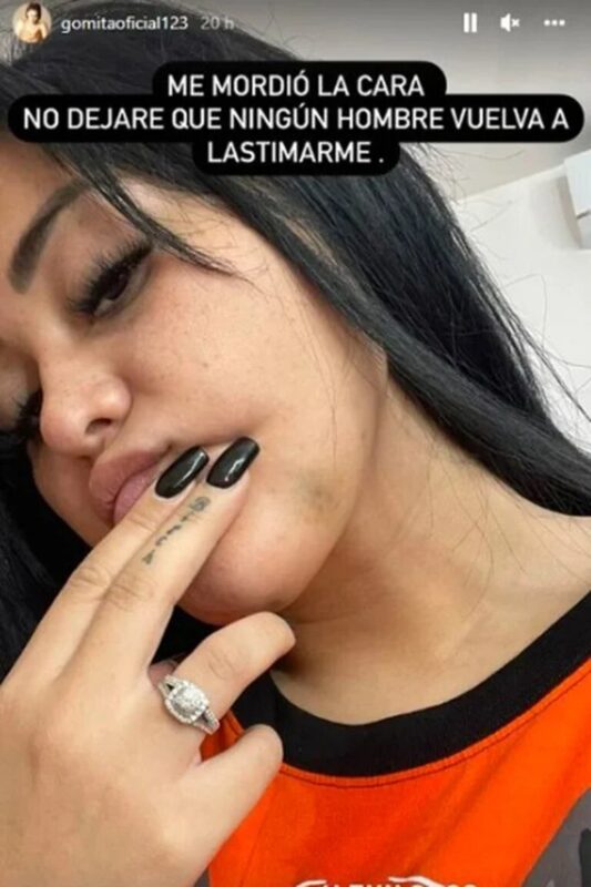 Gomita muestra las agresiones que recibió de su ex novio
