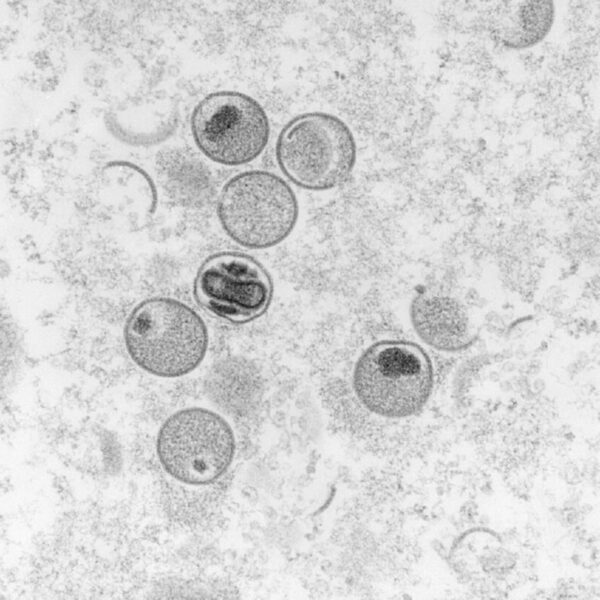 Declara OMS la viruela del mono como emergencia global
