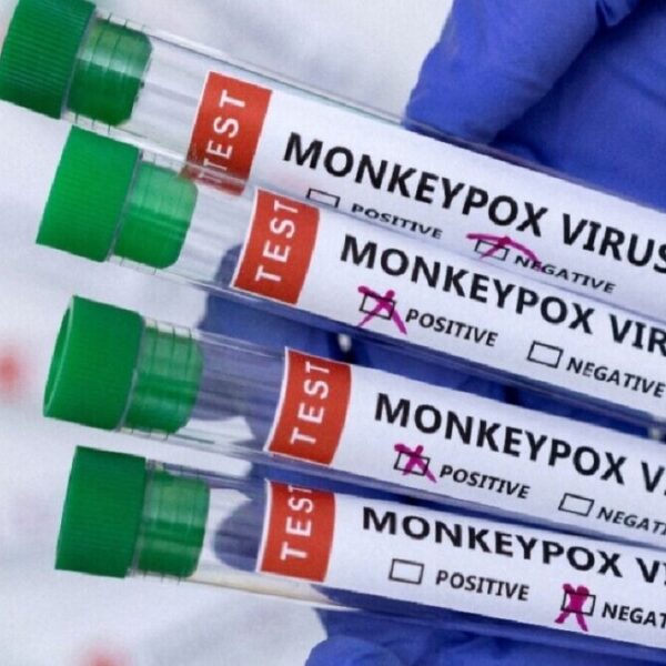 Confirman primer caso de viruela del mono en Tabasco