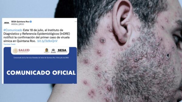 Detectan en Quintana Roo primer caso de Viruela del Mono
