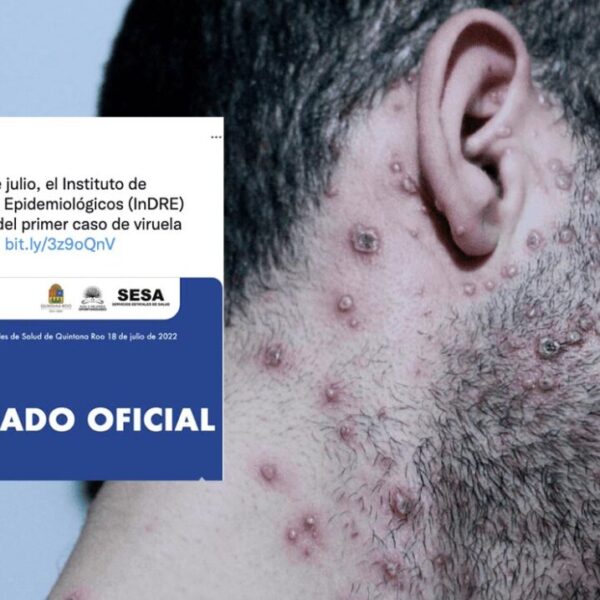 Detectan en Quintana Roo primer caso de Viruela del Mono