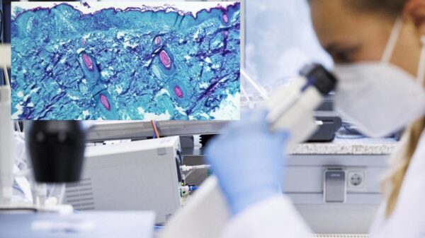 Acumula México 35 casos de Viruela del Mono, la mayoría en CDMX