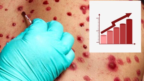 Aumentan un 30.5 por ciento casos de Viruela del mono en México