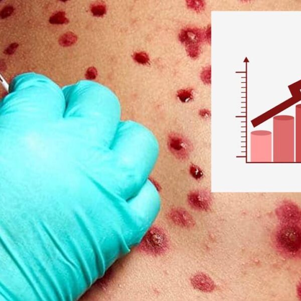 Aumentan un 30.5 por ciento casos de Viruela del mono en México