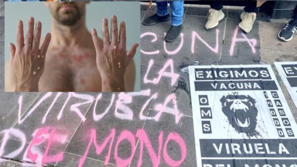 Aumentan casos de Viruela del Mono en México