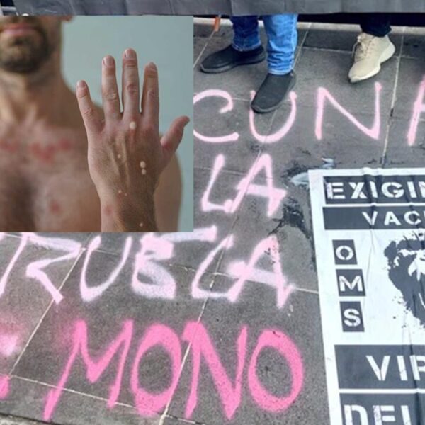 Aumentan casos de Viruela del Mono en México