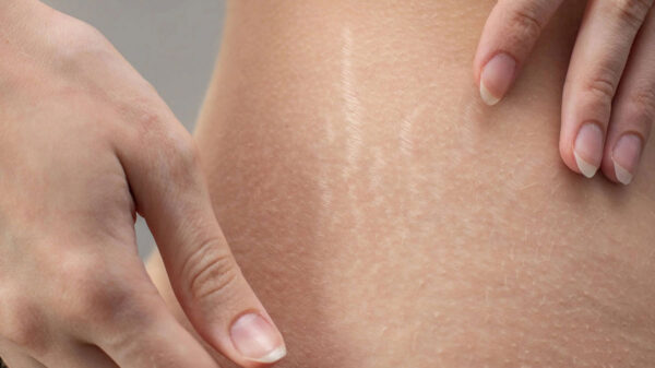 Con estos ingredientes puedes decirle adiós a las estrías