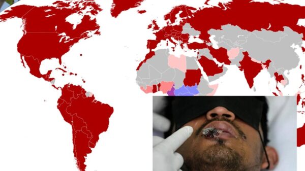Acumula América mayoría de casos de Viruela del Mono 