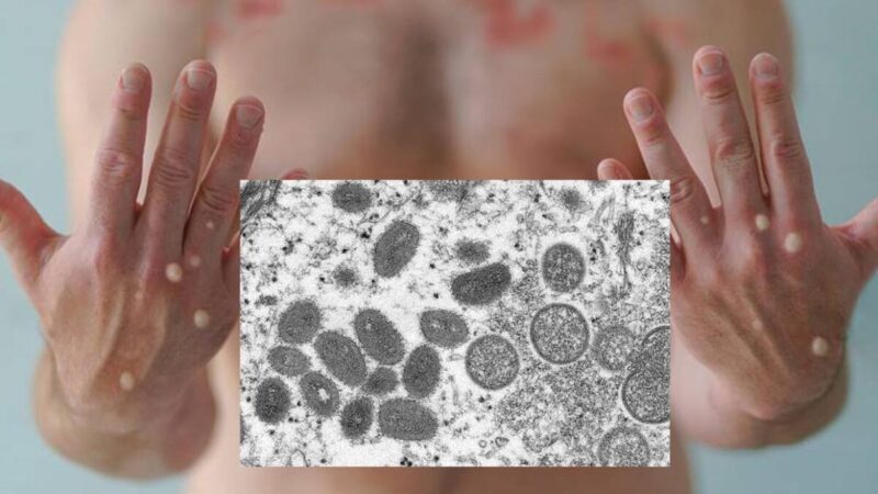 Viruela del mono está ya en casi todo México con mil 51 casos