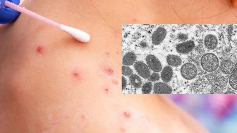 Alcanza México mil 627 casos de Viruela del mono