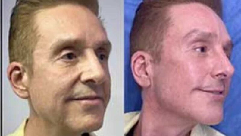 Daniel Bisogno se somete a rejuvenecimiento facial