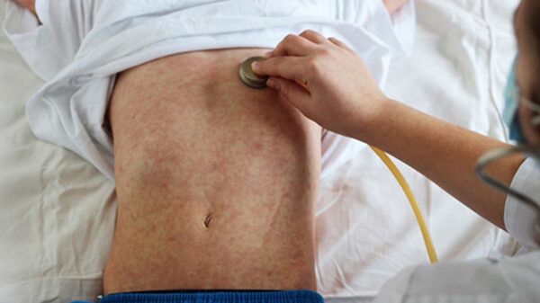 Sarampión amenaza con regresar, hay varios brotes: OMS