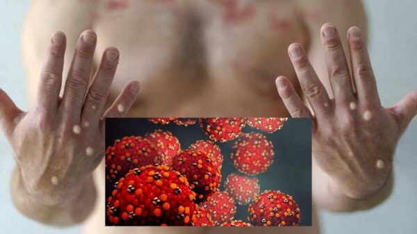 México a casi 2 mil casos confirmado de Viruela del Mono