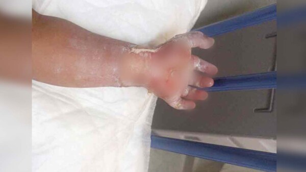 Por una dona, madrastra en Chiapas quema las manos de niños