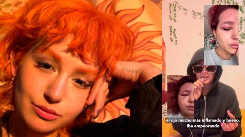 Romina Marcos revela que padece herpes zóster