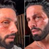¿Qué le pasó? Poncho de Nigris aparece con el rostro golpeado
